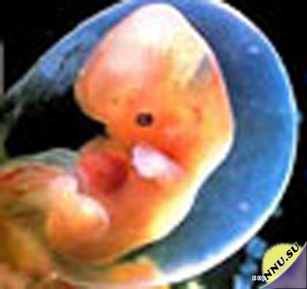 Эмбрион близнеца в животе 9-ти летней девочки